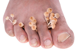 mild toe fungus treatment