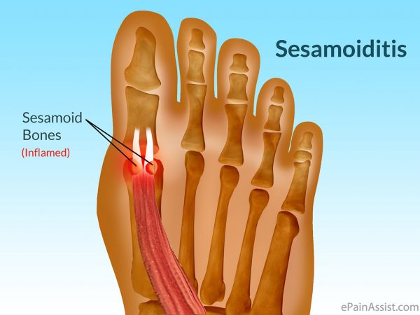 Sesamoiditis foot shop