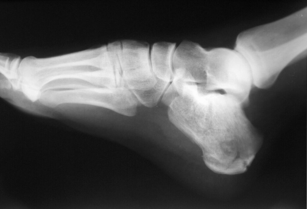 x-ray of stress fractures in foot