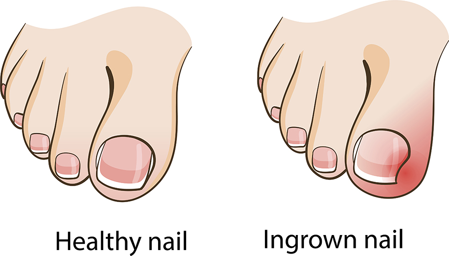 In growth deals toenail