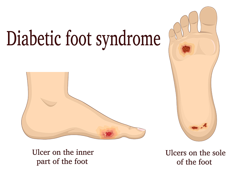 Diabetic Foot Care: Tips for Healthier Feet