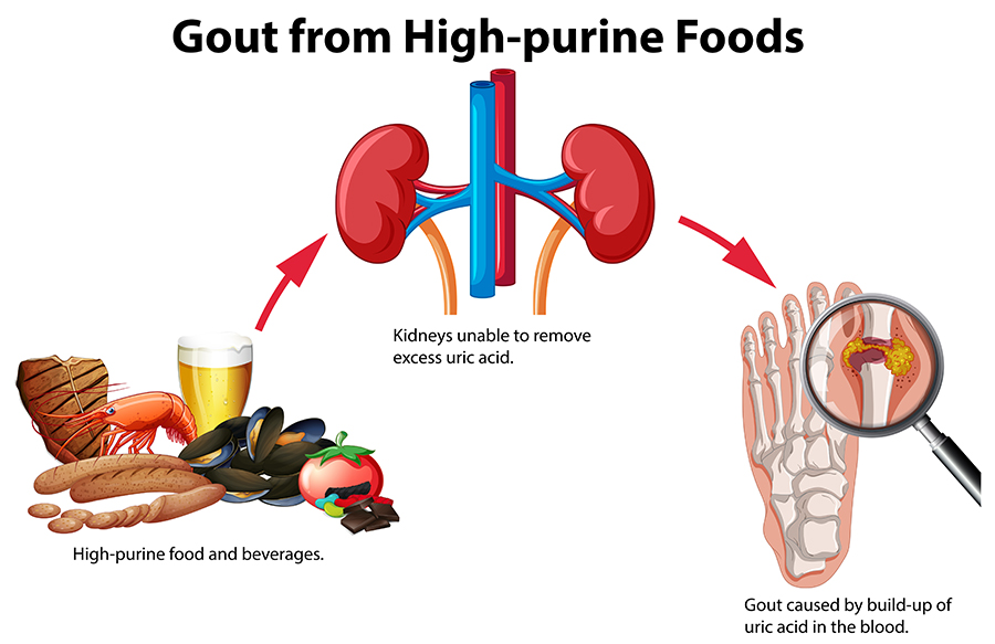 Top Foods That Trigger Gout