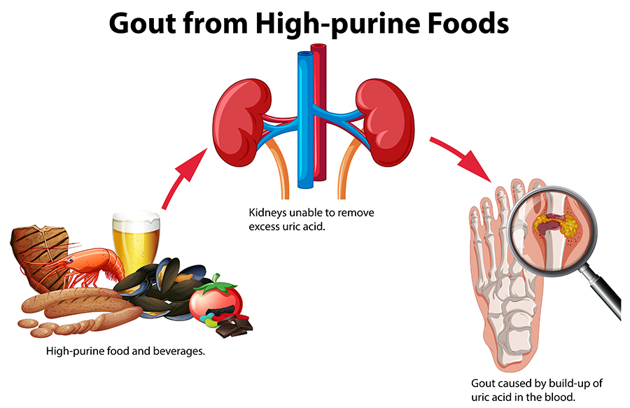 Top Foods That Trigger Gout Red Mountain Footcare Mesa, AZ