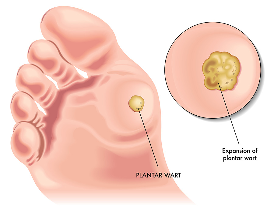 pulling out plantar wart root