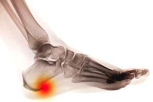 x ray of heel osteophyte