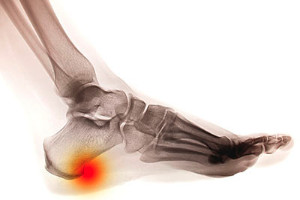 What is a Bone Spur? Causes and Symptoms of Lumbar Osteophytes