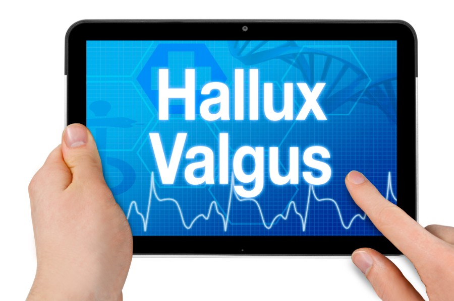 hallux valgus