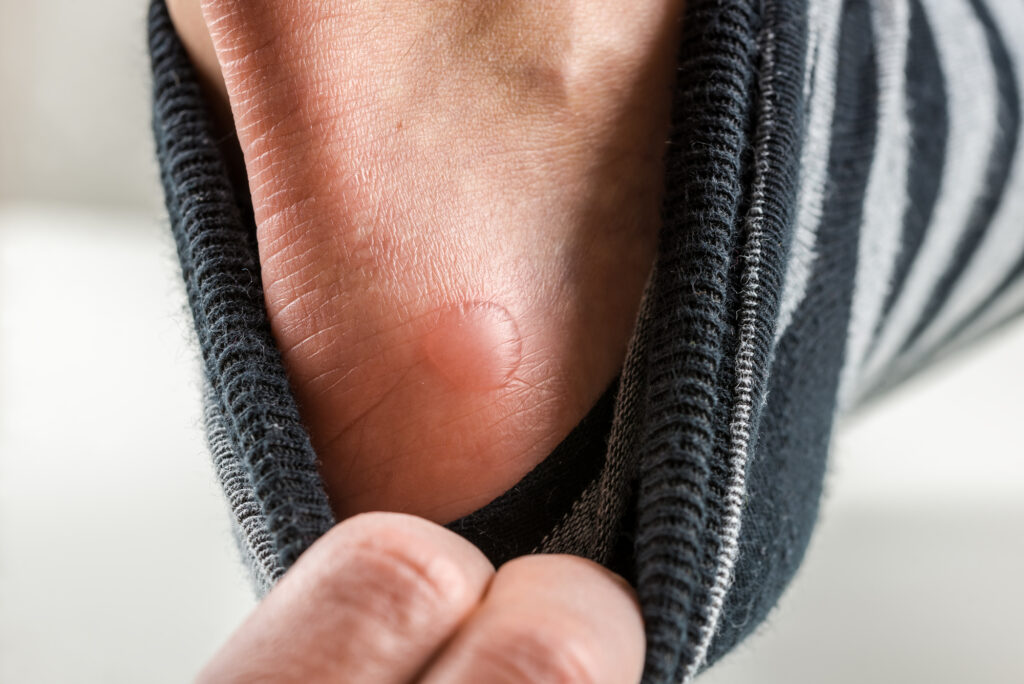 fluid blister on his heel