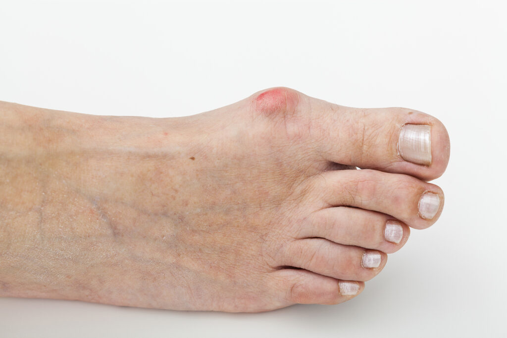 Bunions Causes & Treatments Red Mountain Footcare