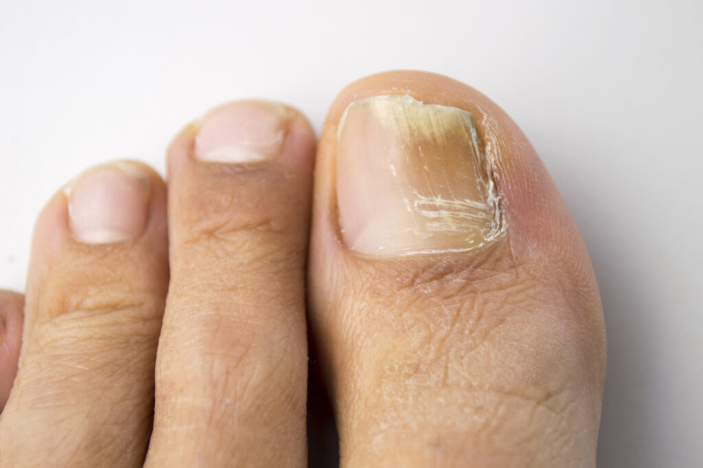 Black spot under toenail