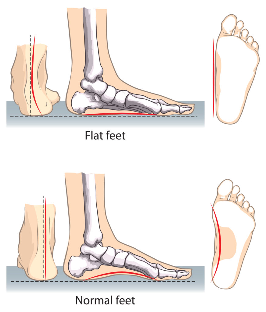  Illustrated side profile view of flat feet versus normal feet.