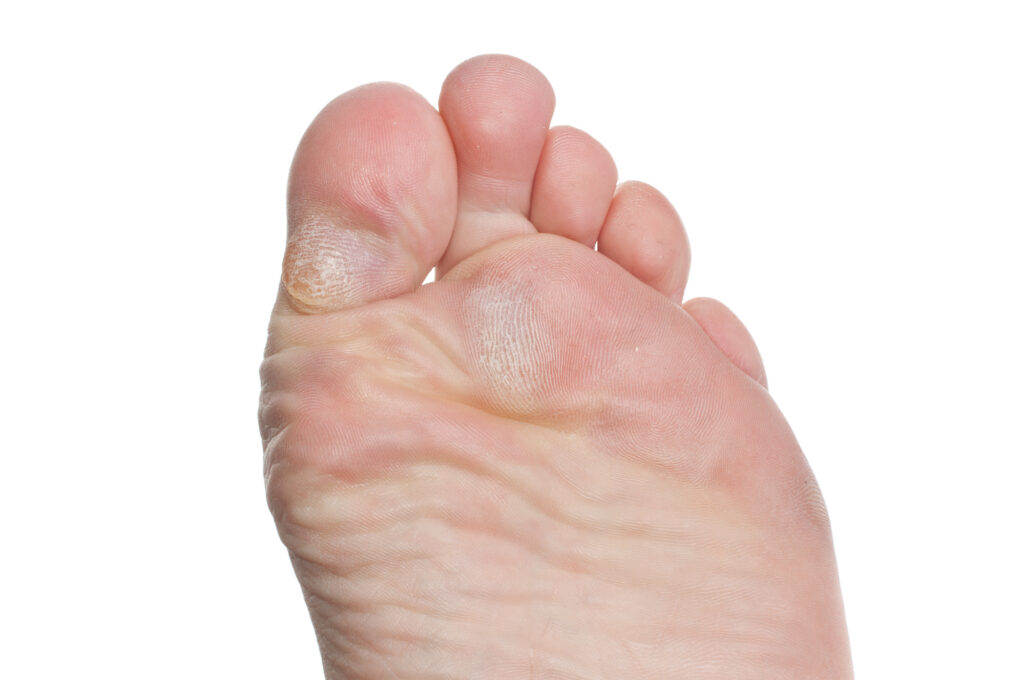 Bottom of foot with calluses on ball of foot and callus on bottom of toe