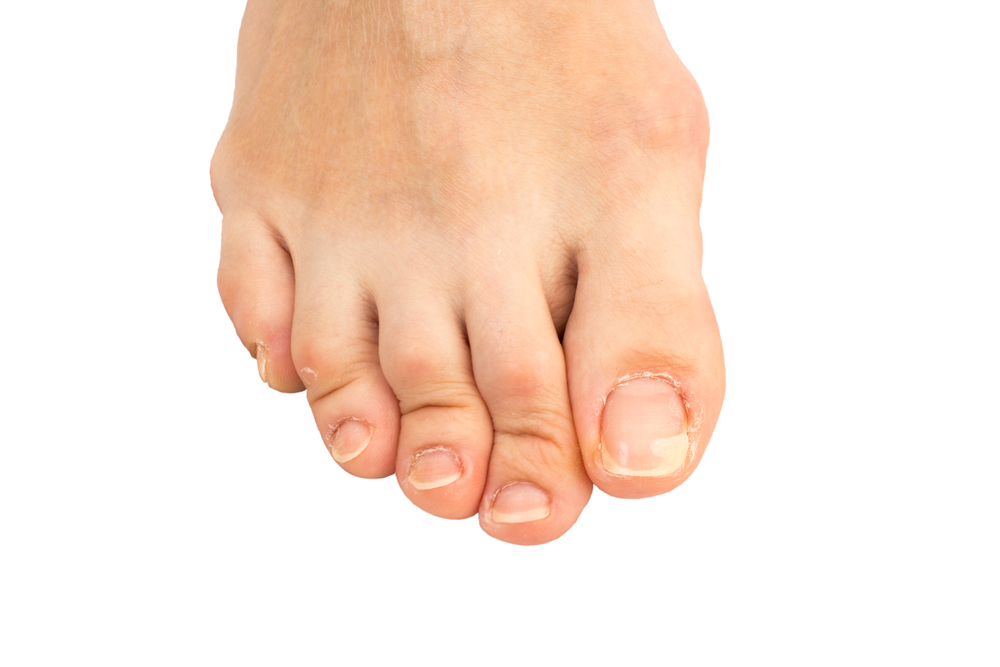 Fixes & Myths About Ingrown Toenails | Optimum Allied Health