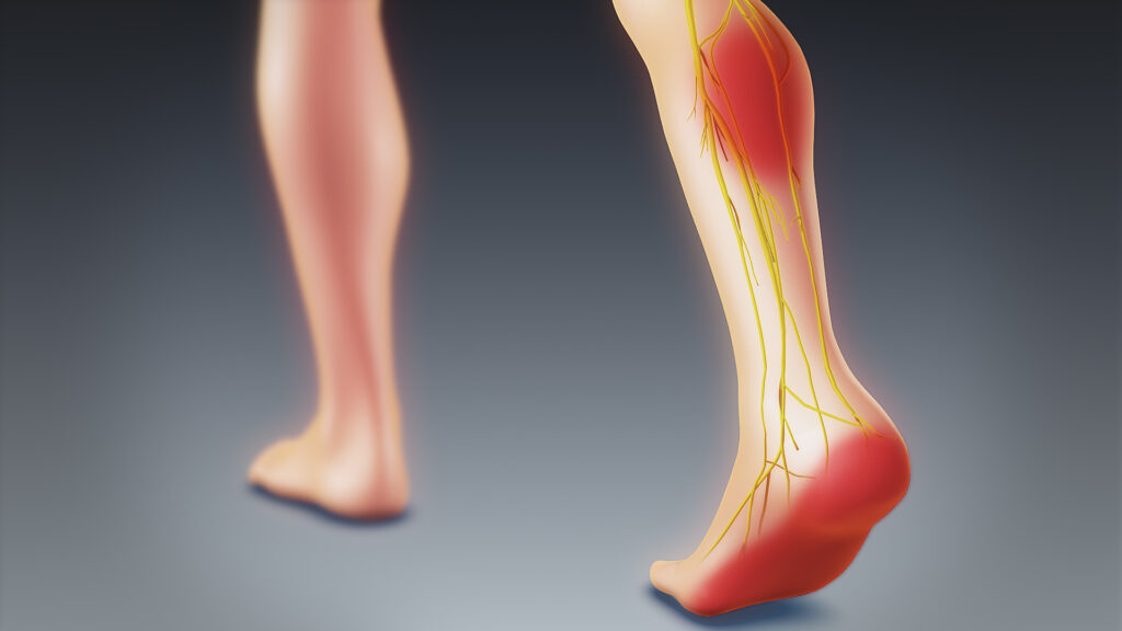 sciatica & sciatic nerve pain in leg and foot