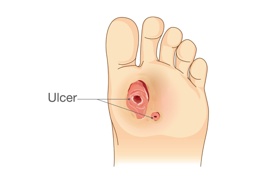 foot ulcer
