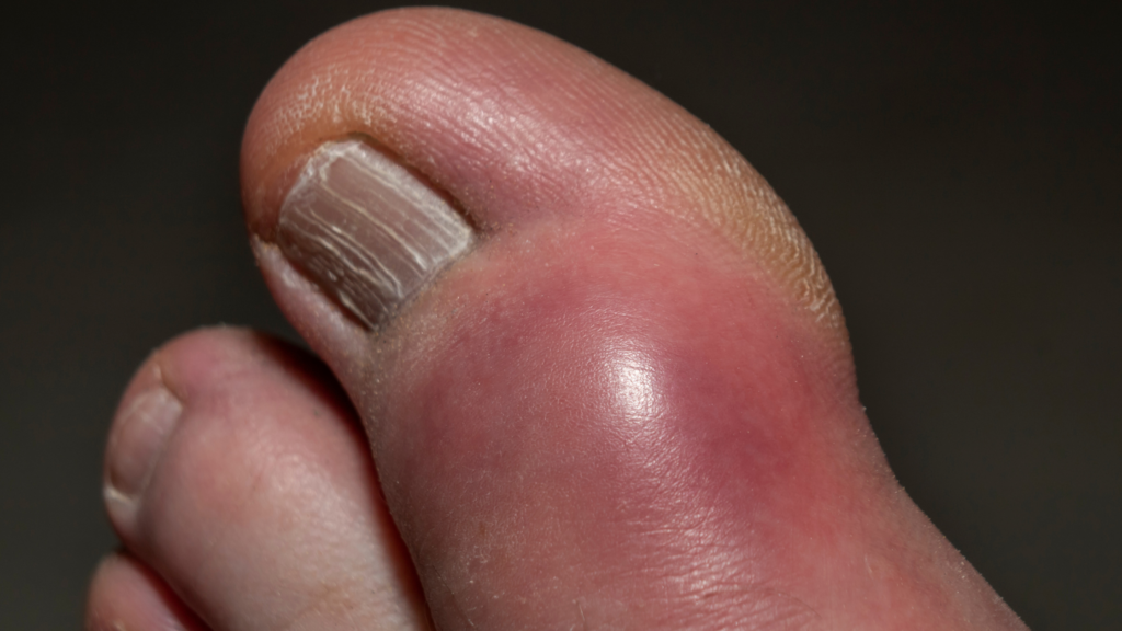 inflamed bunion