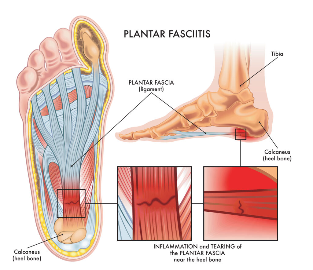 plantar fasciitis anatomy