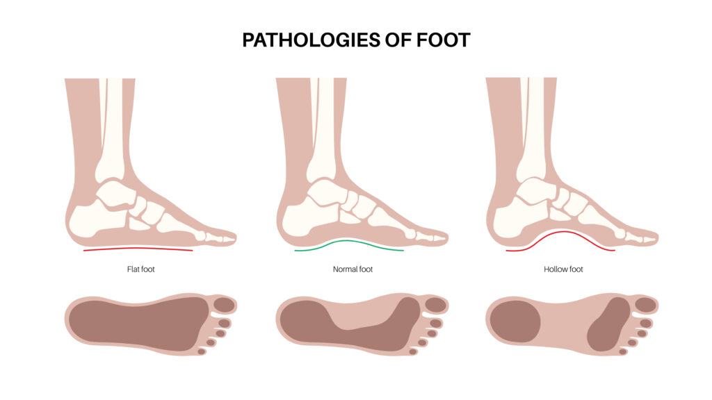 Foot pathologies poster