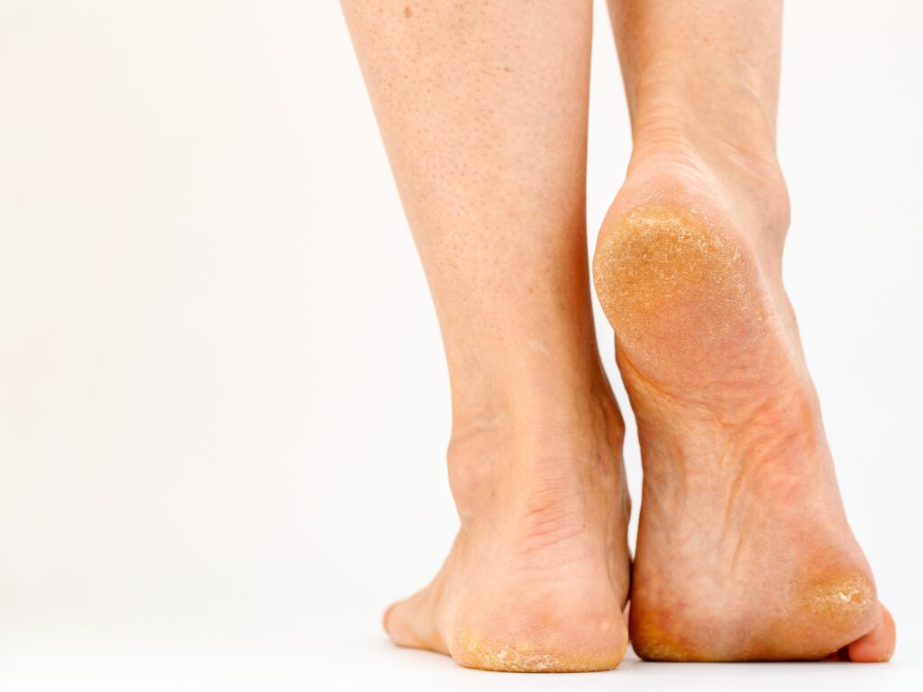 foot calluses