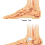 charcot foot