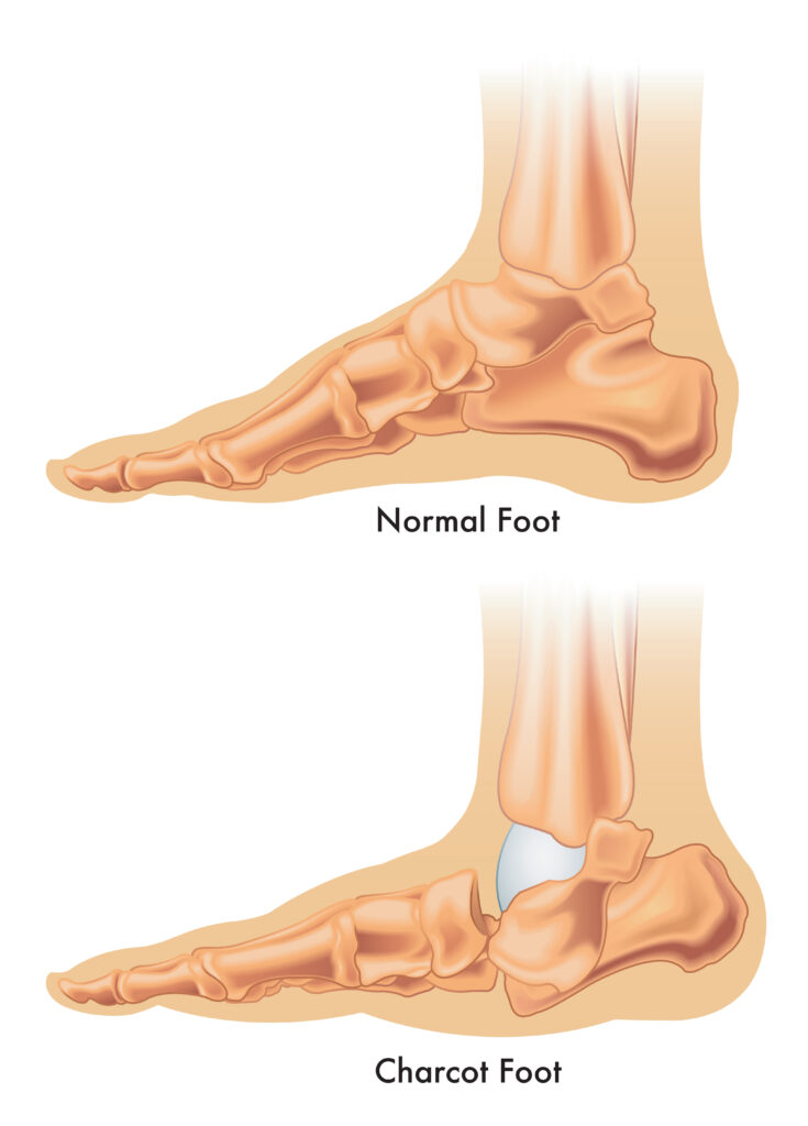 charcot foot