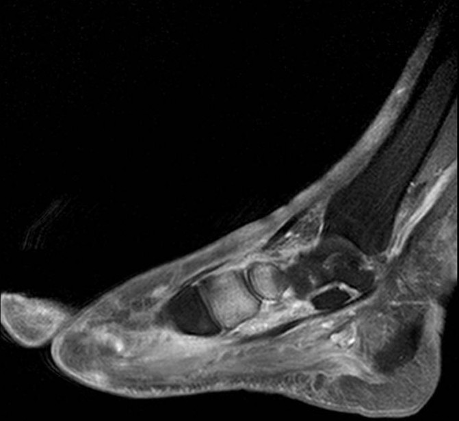 Charcot Foot xray