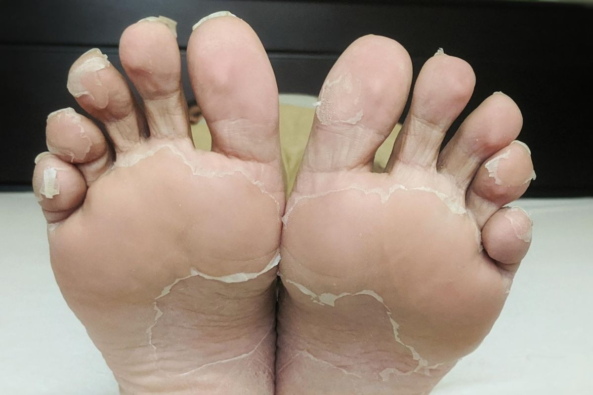 Skin on the bottom of the foot peeling