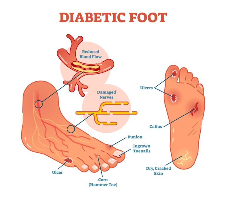 Diagram of diabetic foot conditions: Diabetic neuropathy, PAD, bunion, ingrown nail, corn, ulcer, dry skin, callus