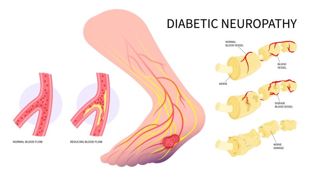 Diabetic Neuropathy: Diagram of the foot and lower leg, showing cross section of foot with normal blood flow vs. reduced blood flow