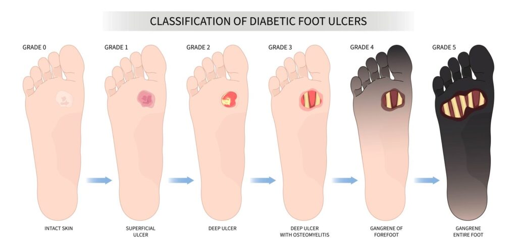 classification of diabetic foot ulcers. Grade 0: the skin is in tact, Grade 1: superficial ulcer is present, Grade 2: deep ulcer on the foot, Grade 3: Deep ulcer with osteomyelitis, Grade 4: gangrene of the forefoot, Grade 5: Gangrene of the entire foot