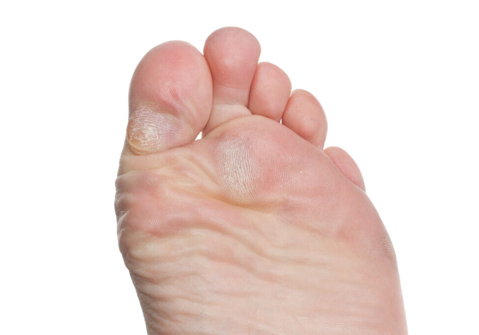 Bottom of foot with calluses on ball of foot and callus on bottom of toe