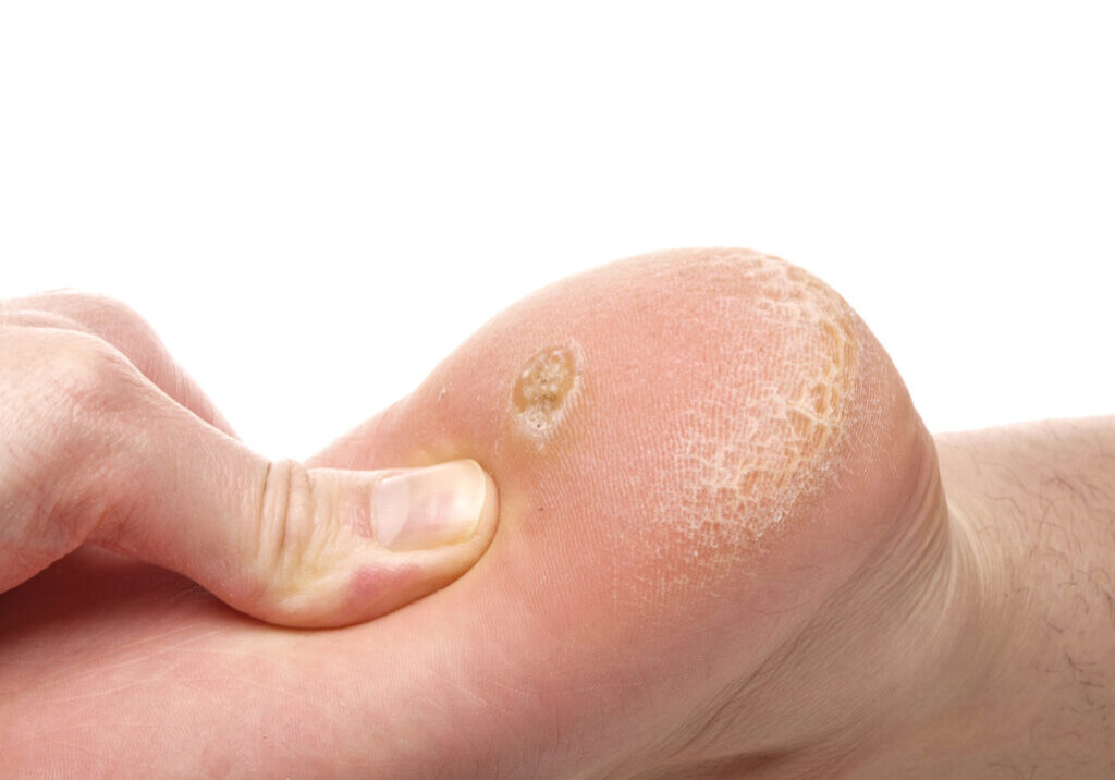 Dermatologist examining a foot for callus and dry skin, towards white