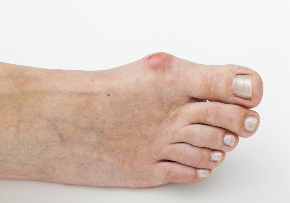 Closeup of a bunion, hallux on foot