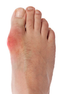 foot with gout in big toe