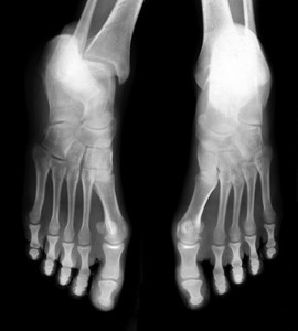 foot stress fractures